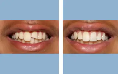 Before and After